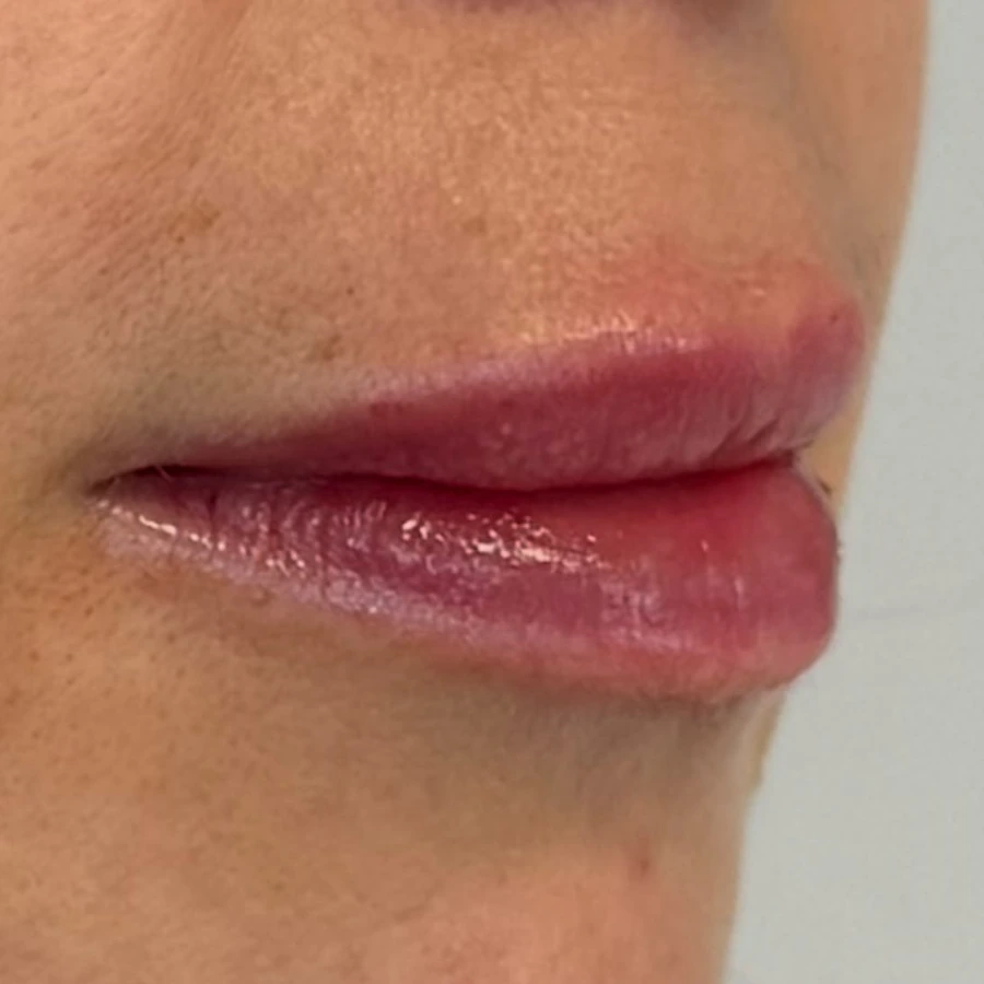 Client example 1: lips after lip-filler treatment, viewed from the side.