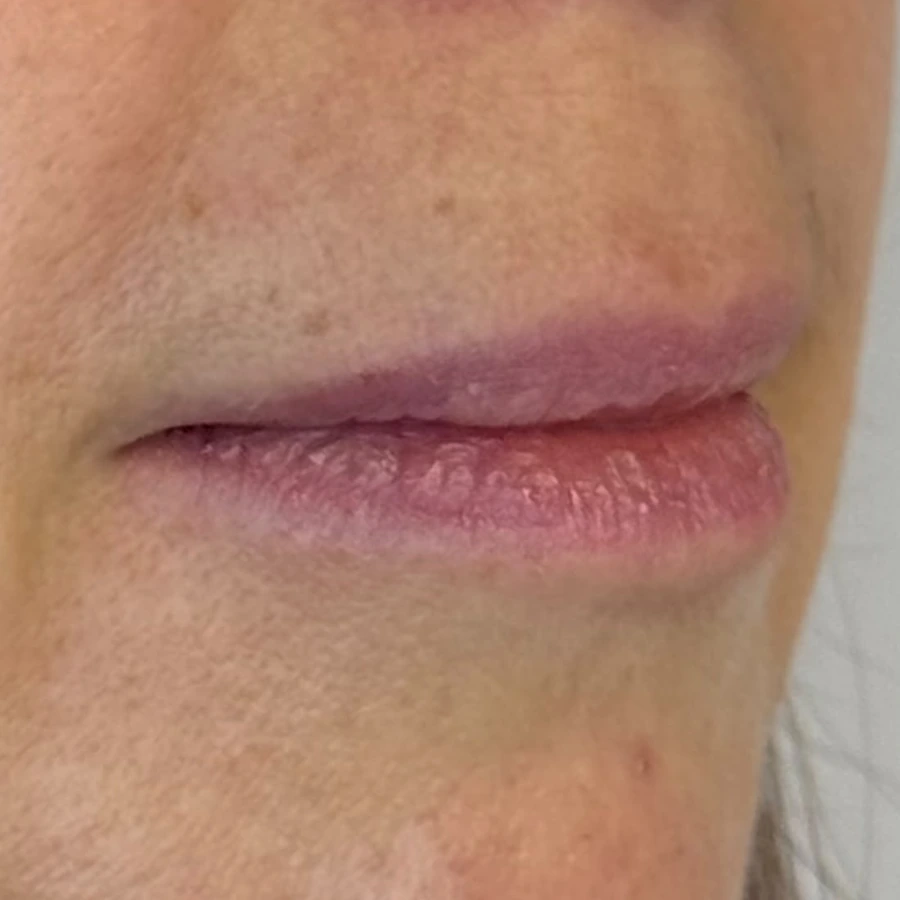 Client example 1: lips before lip-filler treatment, viewed from the side.