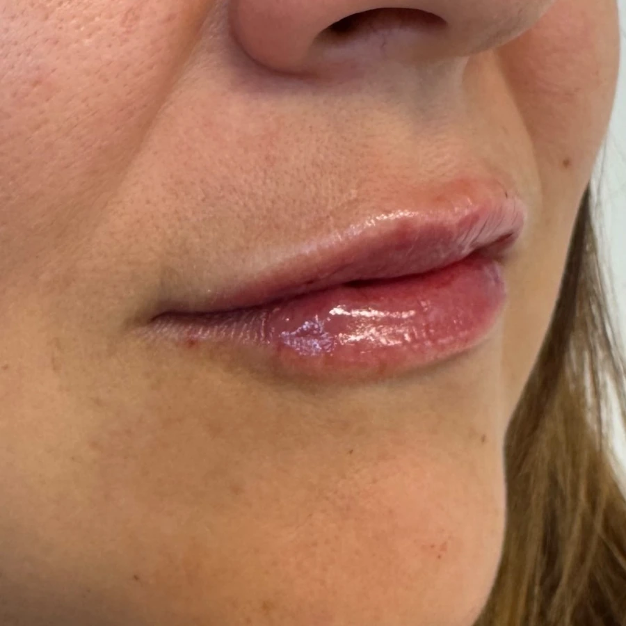 Client example 2: lips after lip-filler treatment, viewed at an angle.