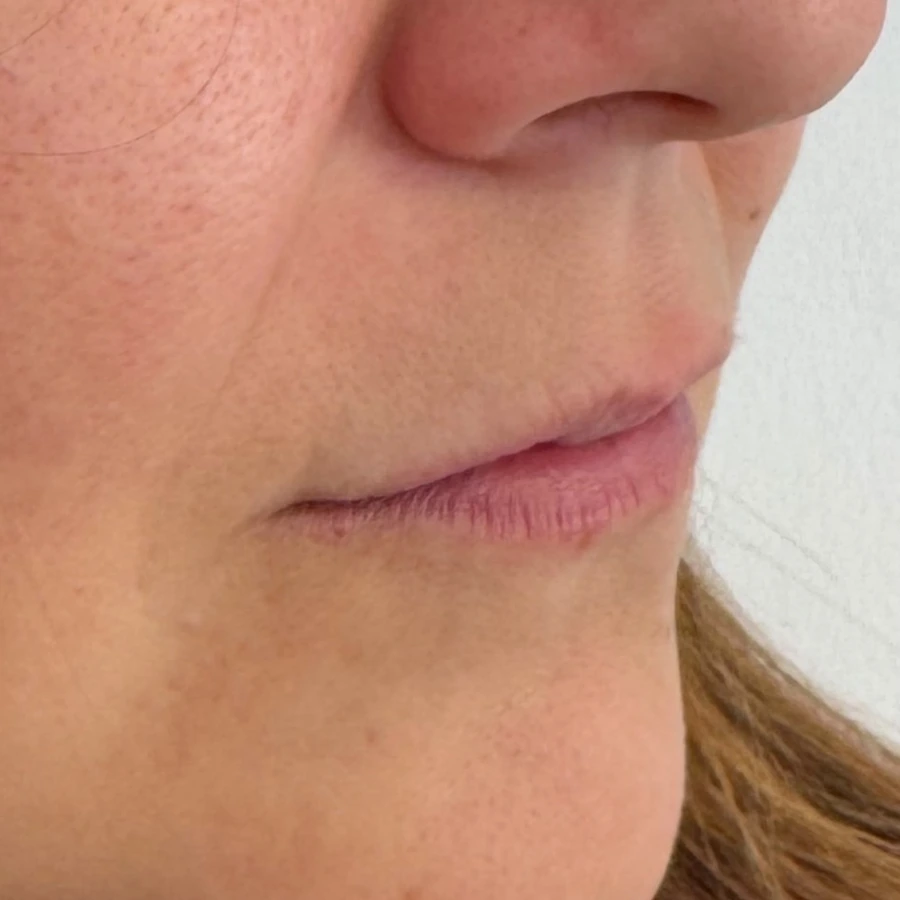 Client example 2: lips before lip-filler treatment, viewed at an angle.